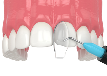 Illustration of bonding material being applied to a tooth