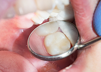 Close up of dental mirror in mouth reflecting a white tooth