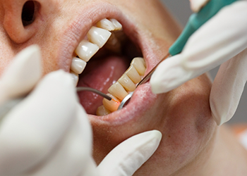 Close up of dental patient receiving laser gum treatment