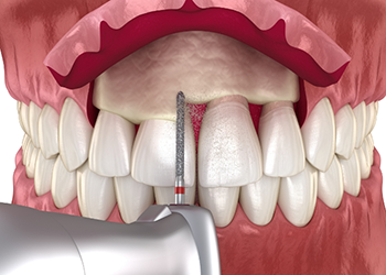 Illustrated dental instrument correcting an uneven gumline