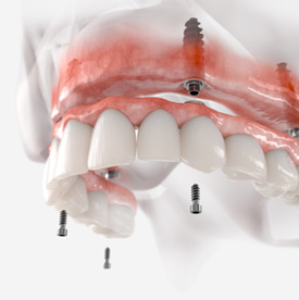 Illustration of a denture being supported by dental implants