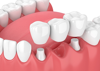 Illustrated dental bridge being placed to replace a missing tooth