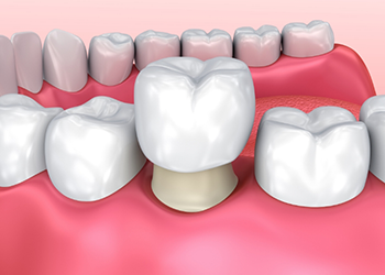 Illustrated dental crown being fitted over a tooth