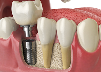 Illustrated dental implant and crown replacing a missing lower tooth