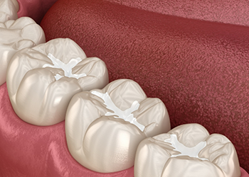 Illustrated row of teeth with dental sealants