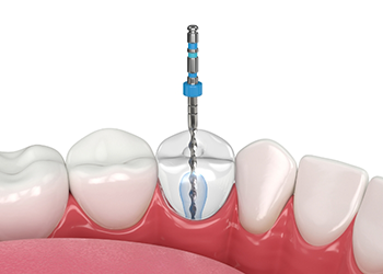 Illustration of thin dental instrument treating inside of a tooth