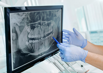 Dentist gesturing to screen showing x ray of teeth