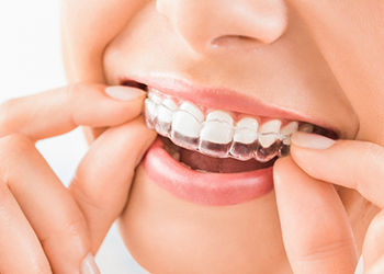 Close up of person placing an Invisalign aligner over their teeth