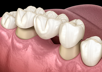 Illustrated dental bridge being placed to replace a missing tooth