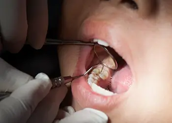 Close up of child having their teeth examined by dentist