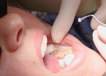 Dental patient receiving a filling