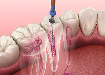 Illustration of dental instrument treating the inside of a tooth