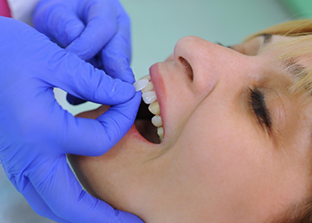 Dental patient having a veneer placed over their tooth